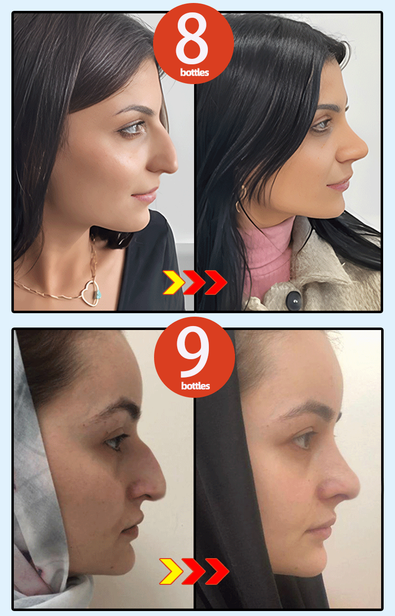 nose lift up essential oil beautiful nose high - AliExpress 66