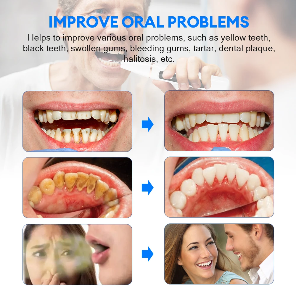Limpiador de dientes ultrasónico, escalador Dental y cepillo de dientes eléctrico rotativo, placa, cálculo, eliminación de sarro, juego de herramientas de limpieza Dental » Limpiador de dientes ultrasónico