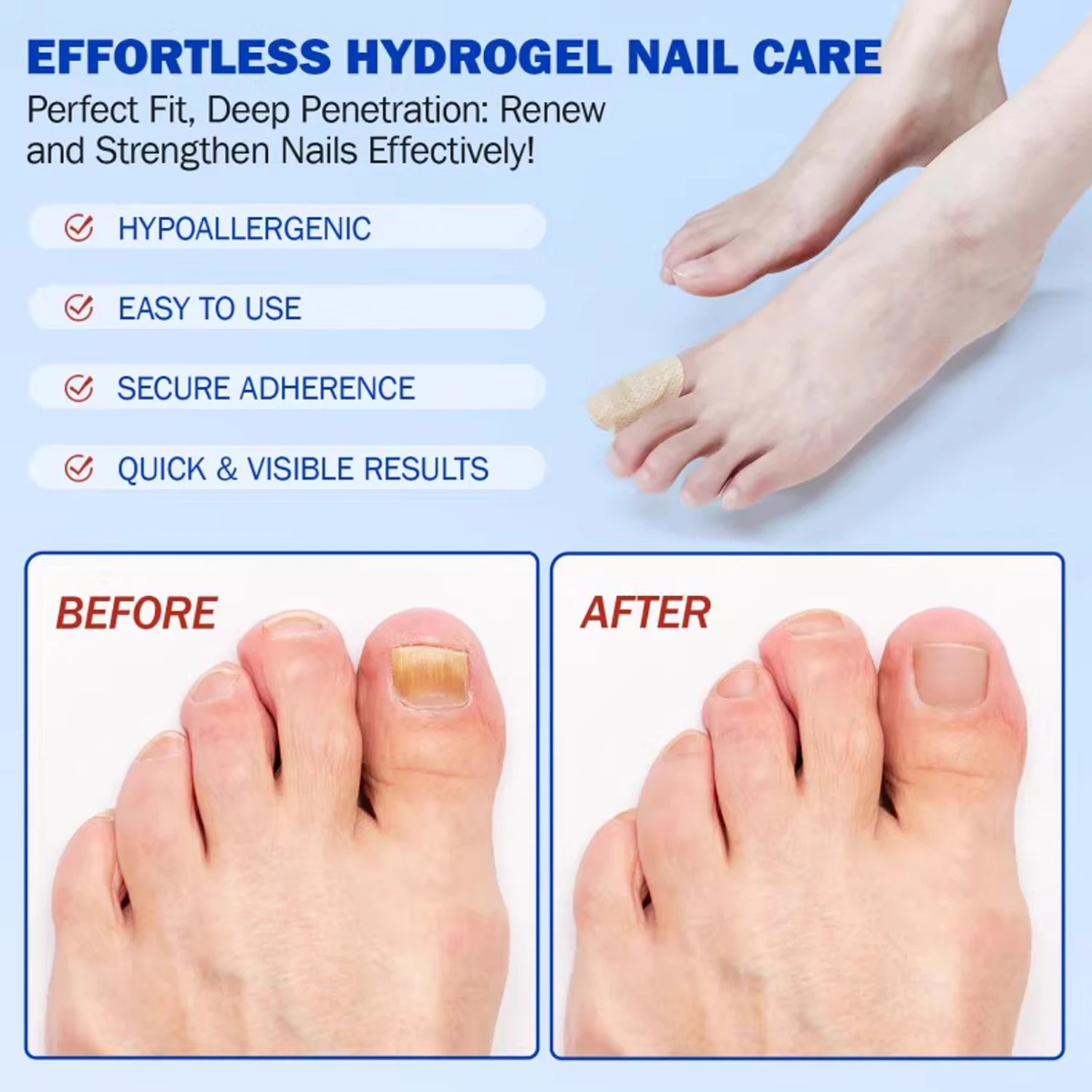 Ingrown Toenail Correction Patch Waterproof Nail Repair Tool Set_voghion.com