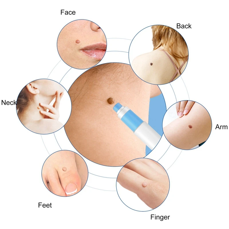 Skin Tag Removal Kit Painless Skin Tag Removal Pen Easy Device Removes 4Mm-9Mm Tags