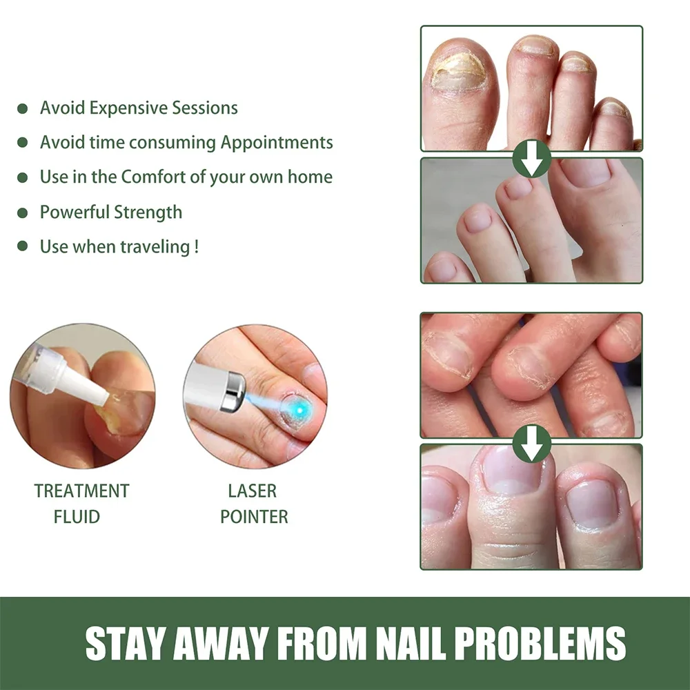 Toenail Laser Nail Fungus Treatment Laser Pen Anti Fungus Infection Fungal Remove Dispel Leuconychia Liquid Onychomycosis Grow