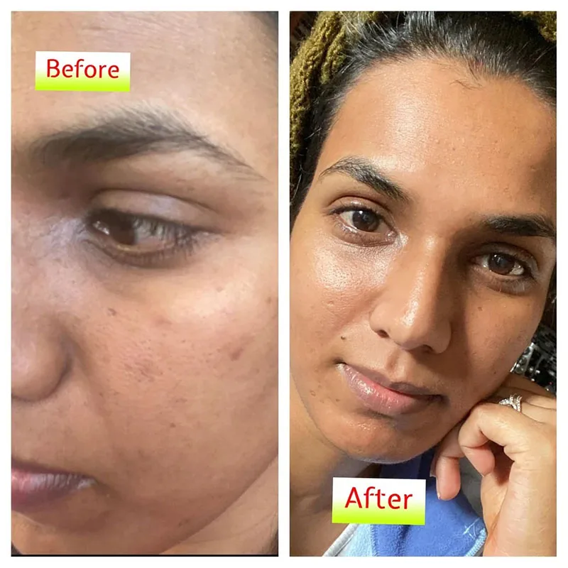 Facial Whitening Cream Solution for Darkness Around Mouth Allantoin Secret To Get Glowing Glass Skin Gain Lightening Smooth Face