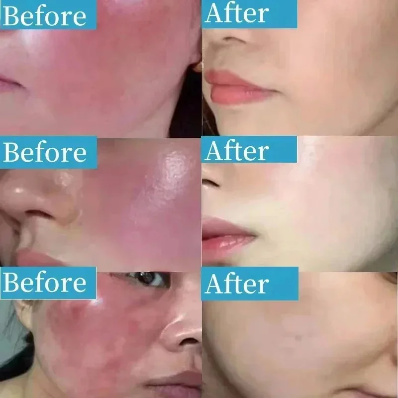 Repair Facial Redness Serum Instant Spider Vein Remove Sensitive Skin Sooth Anti Redness Rosacea Treat Lotion Korean Cosmetics 3