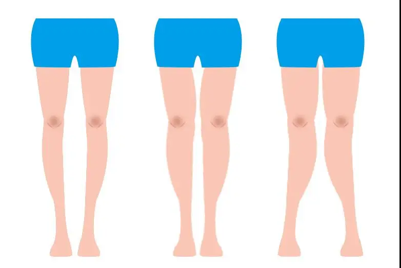 O leg orthotics straight leg leggings xo leg correction body protector x leg orthotics high quality products