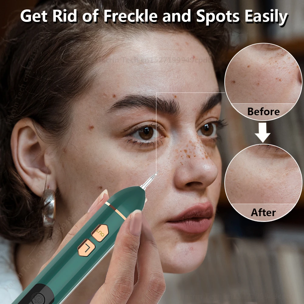 Plasma Laser Pen Skin Tag Remover Wart Mole Spots Freckles Dark Dpot Black Dots Nevus Flat Blemish Pimples Removal Face Body