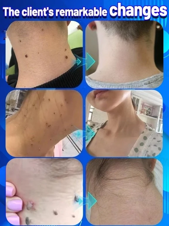 Mini Laser per la rimozione del gel - Rimozione indolore ed efficace, essenziale per la cura della pelle._voghion.com