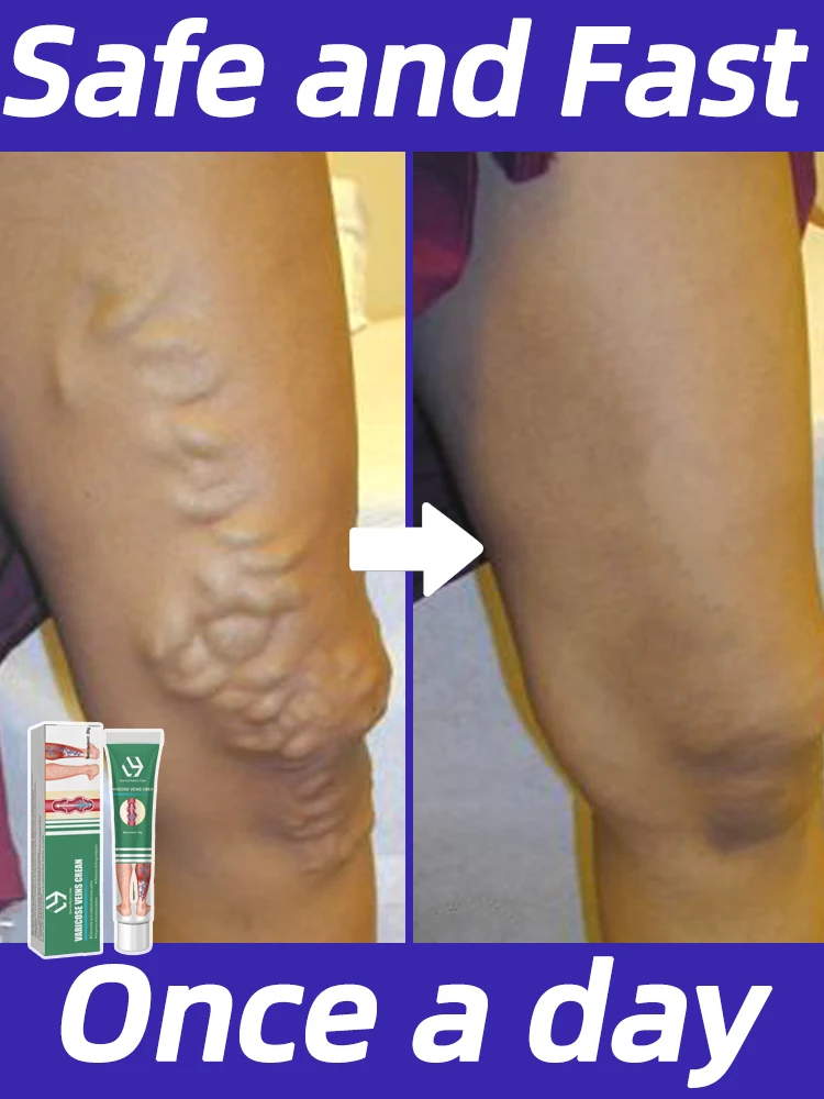 

Varicose Cream