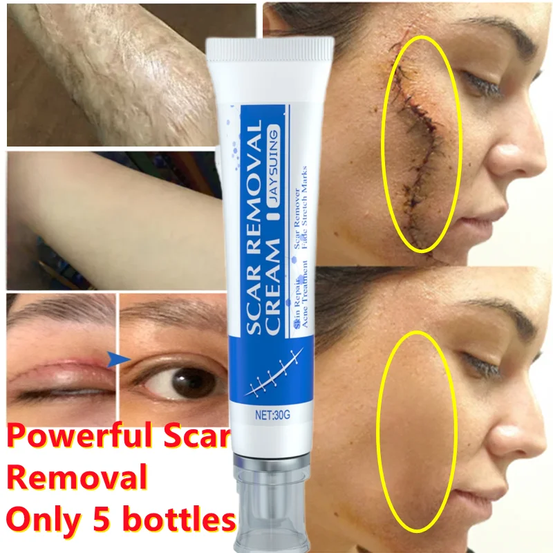 7 Days Fast Scar Removal Cream Repair Burns Scalding Surgery Stretch Marks Old Scars Treat Acne Marks Whiten Skin Care Products