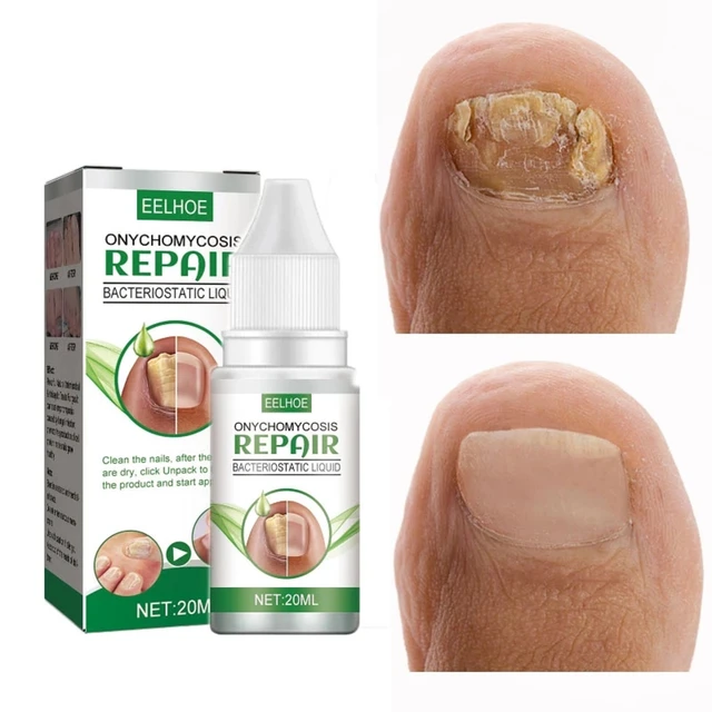 The 6 Best Toenail Fungus Treatments of 2024