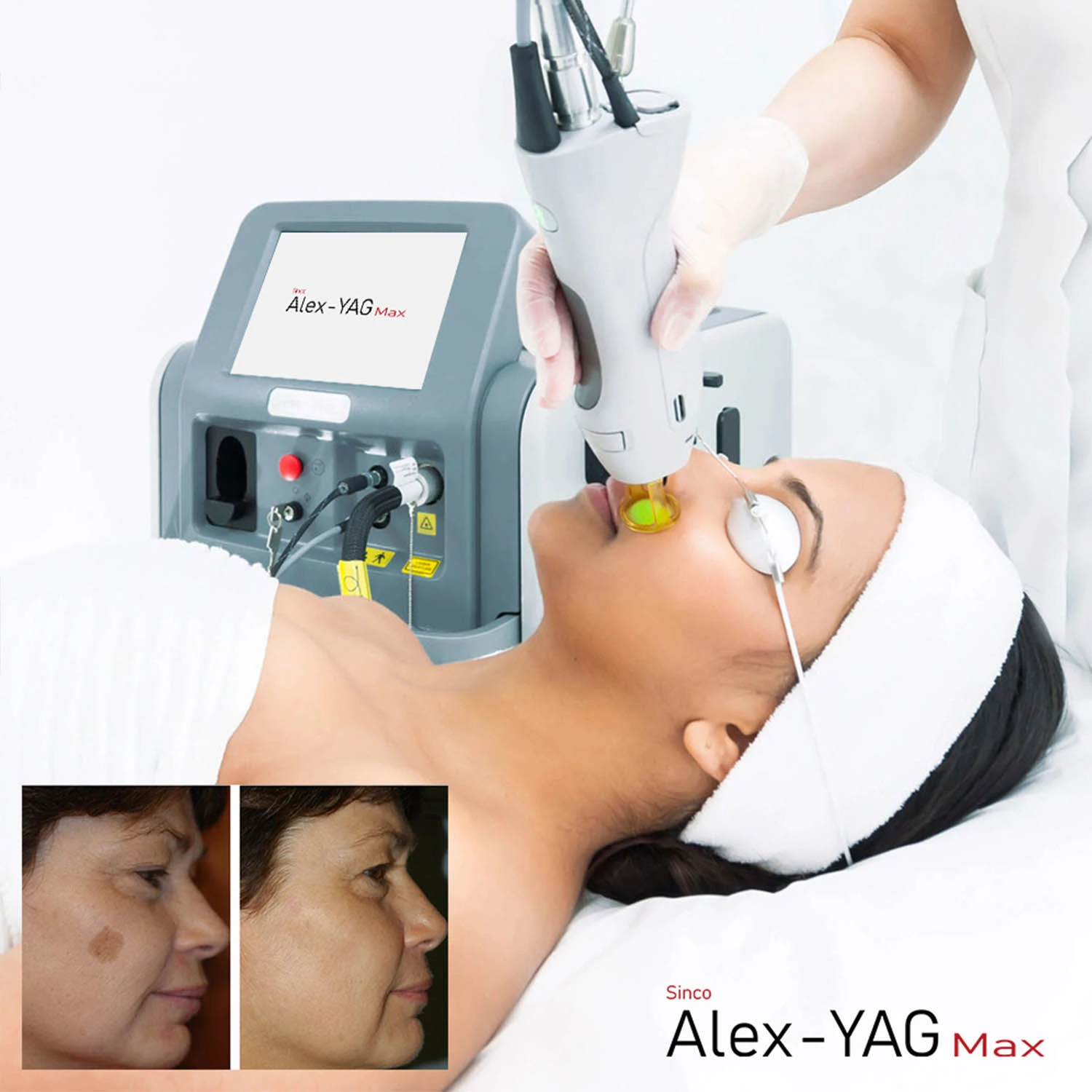 Pro Alexandrite Laser 755nm 1064nm Hair Removal Machine Permanent Painless  Picosecond Bikini Hair Removal Tattoo Removal - Tattoo Accesories -  AliExpress