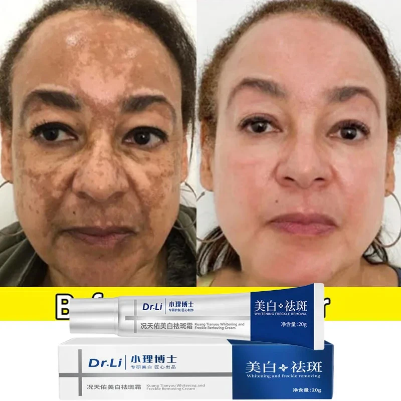 

Effective Whitening Freckles Cream Remove Black Spots Melasma Dark Fade Pigmentation Moisturize Brighten Face Skin Care Product