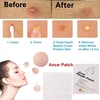 3 bag (1 bag 24pcs ) Face Acne Pimple Spot Scar Care Treatment Stickers Blackhead Removal Freckle Patches Acne Stickers 3