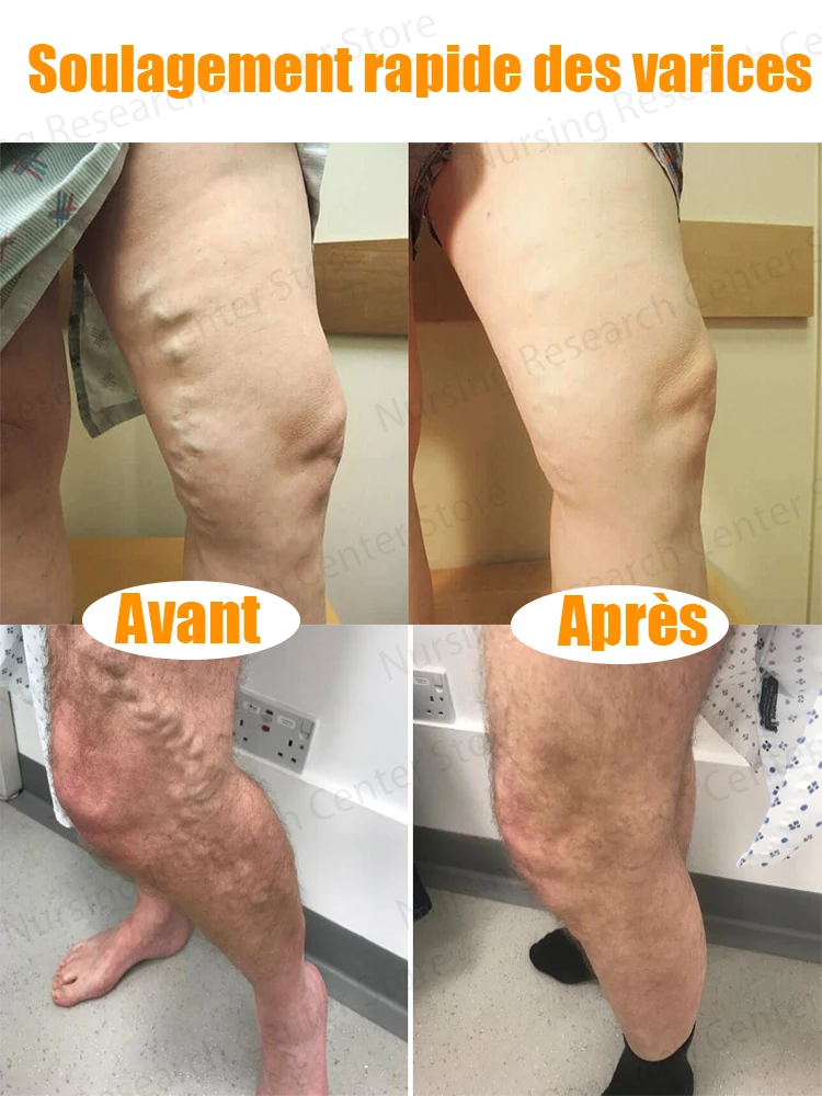 Pulse Massage Patch Eliminates Varicose Veins And Effectively Improves Blood Circulation_voghion.com