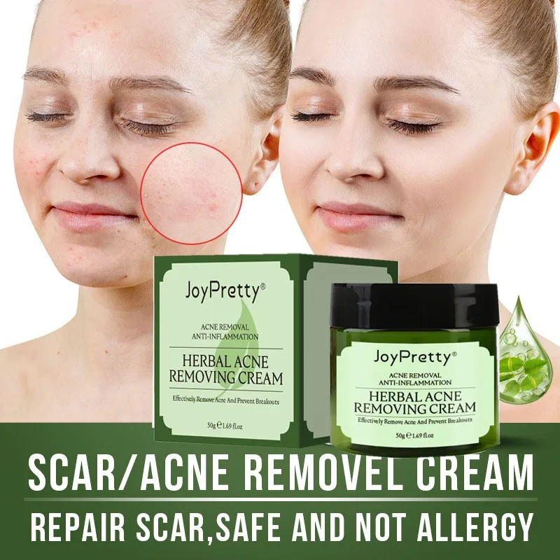 

Natural Herbal Acne Treatment Face Cream Facial Pimple Scar Remove Oil Control Against Acne Day Creams Moisturizing Skin Care