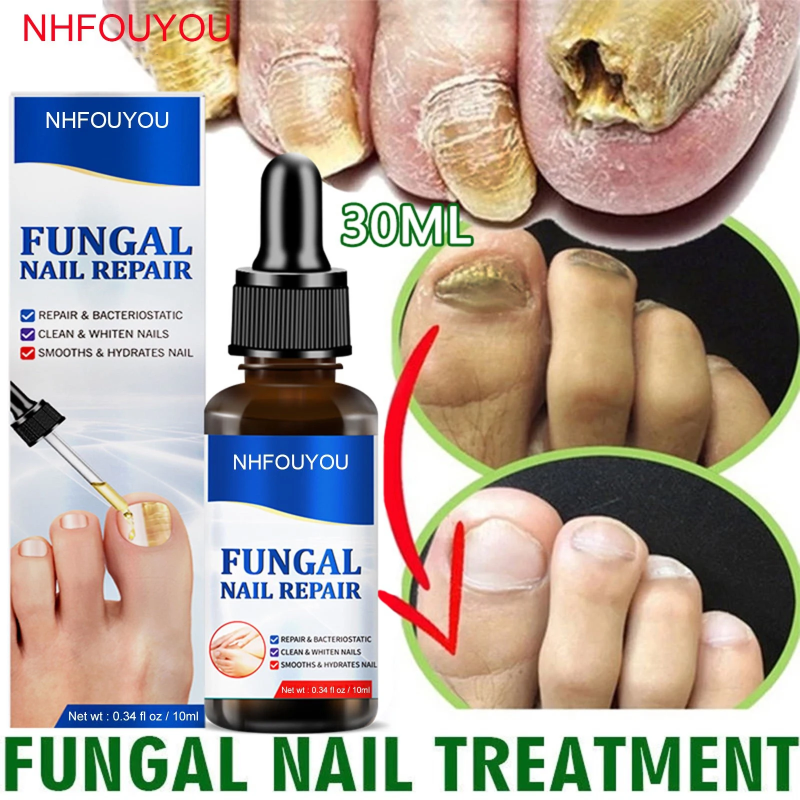Fungal Nail Treatment Oil Foot Repair Essence Toe Nail Fungus Removal