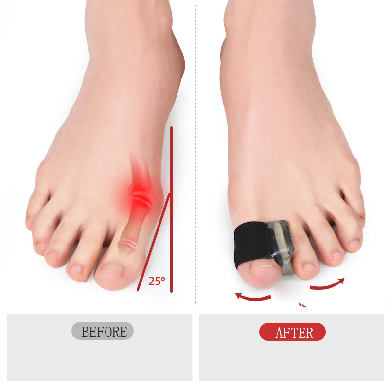 Toe separator 1Pair Big Bone Thumb Toe Separator Bunion Splint Straightener Corrector Foot Care Tools Hallux Valgus Protector Orthotics