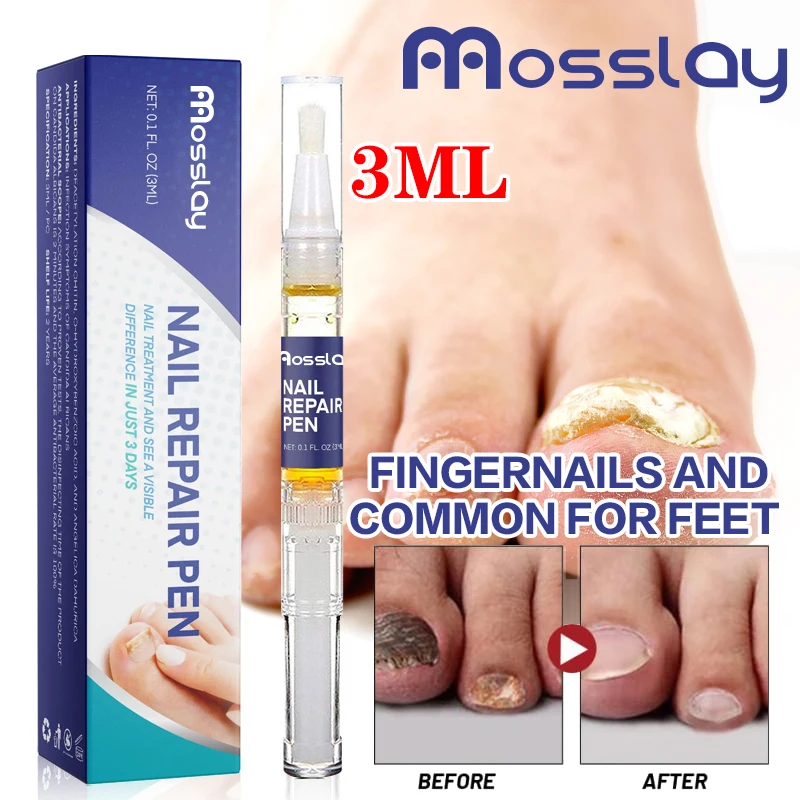 

Onychomycosis Nail Fungus Treatment Essence Serum Care Oil Hand and Foot Care Nails Fungal Removal Repair Gel Anti-infective