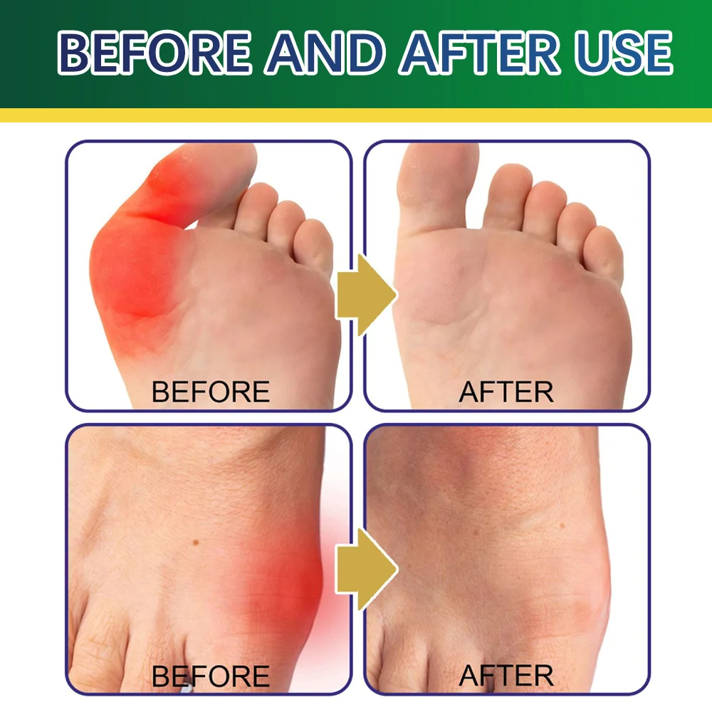 Thumb Pouch Joint Patch Thumb Eversion Foot Joint Herbal Care Patch Anti Bunionpatch Relieves Pressure Pain Prevents Bunion