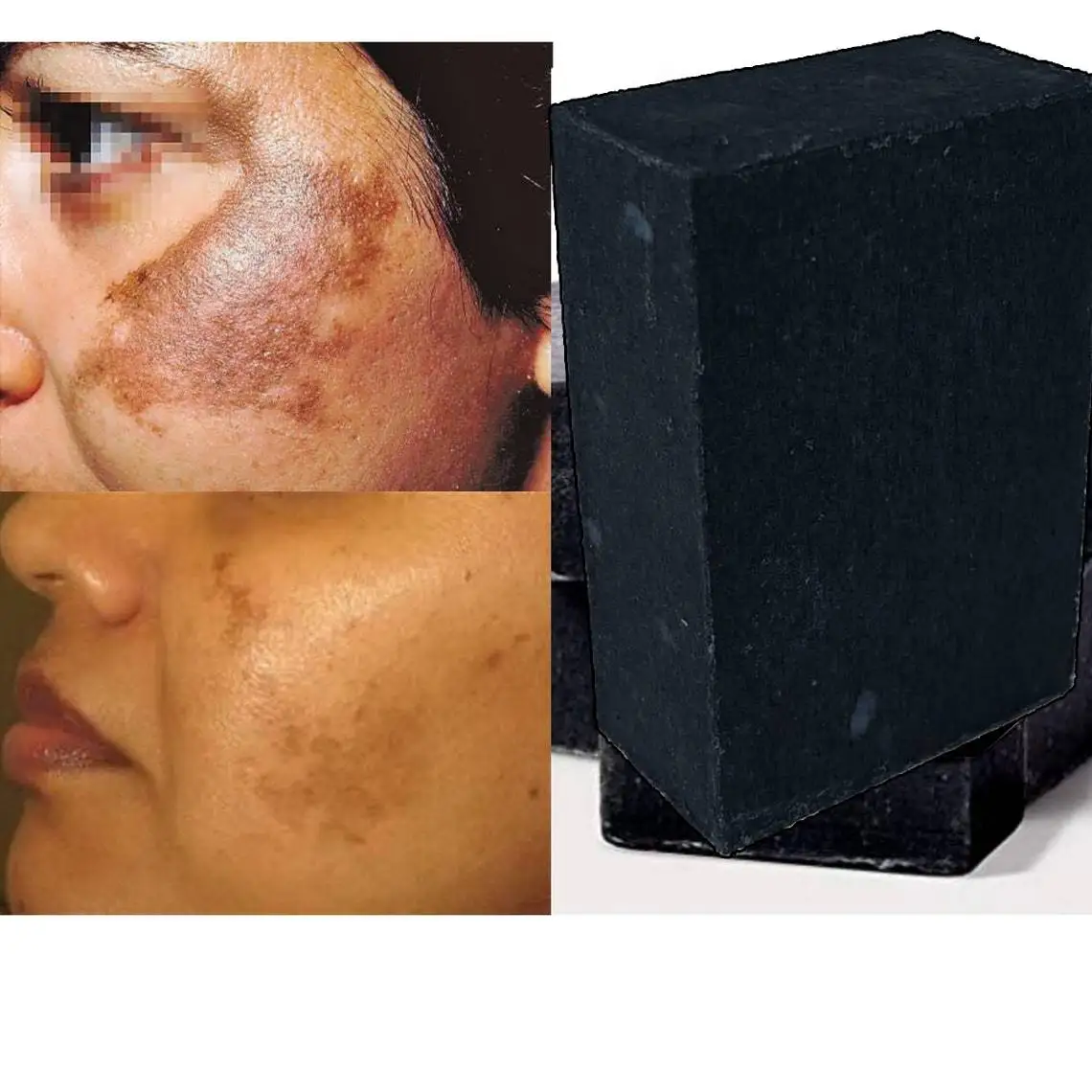

Kojic Activated Soap, Dark Spots, Age Spots, Sunburn , Brighter Skin,Glowing Skin