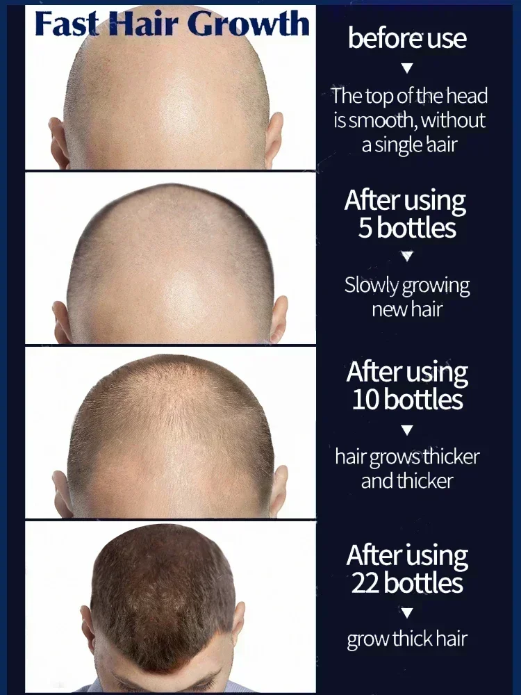 Hair growth serum,hair building powder,hair building fibers,hair growth spray,hair growth cream,hair growth shampoo set