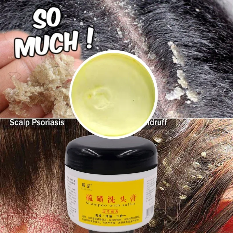 

Oil Control Cleaning Damage Repair Strong And Prevent Hair Breakage Sulfur Shampoo To Remove Lice Mites Dandruff Itching