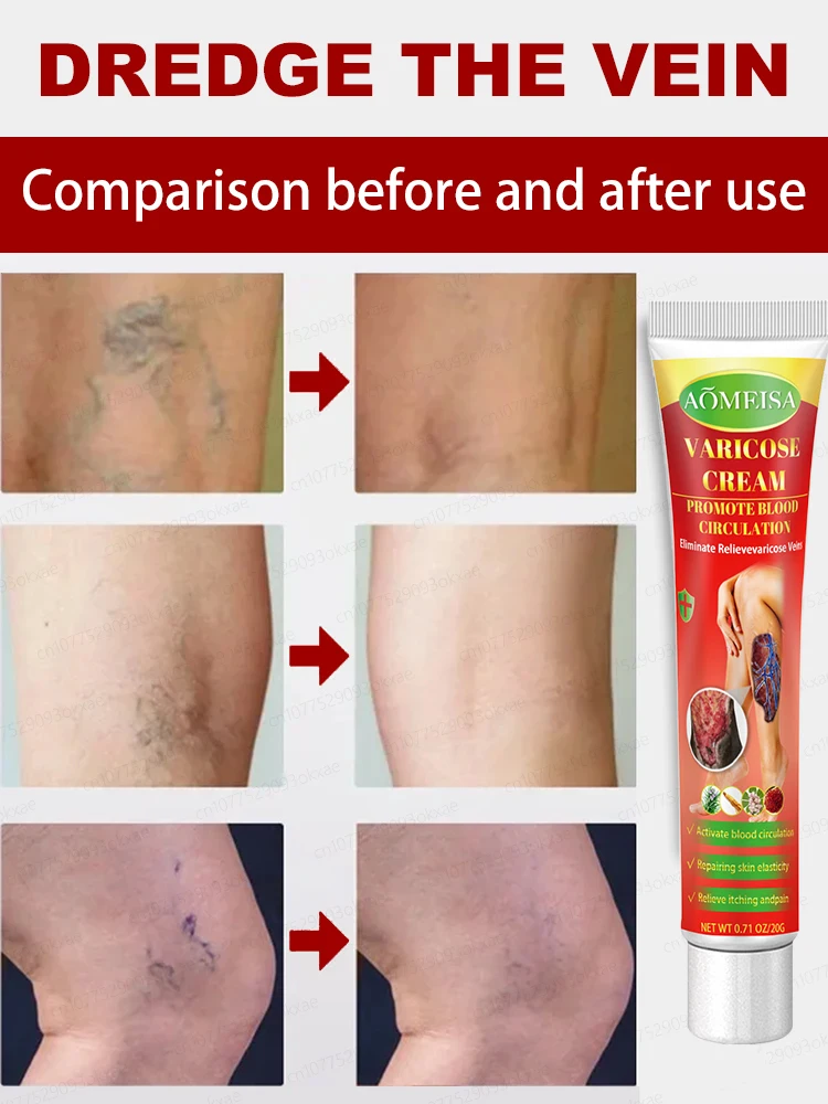 Varicose vein ointment, repair varicose veins and vasculitis in 7 days
