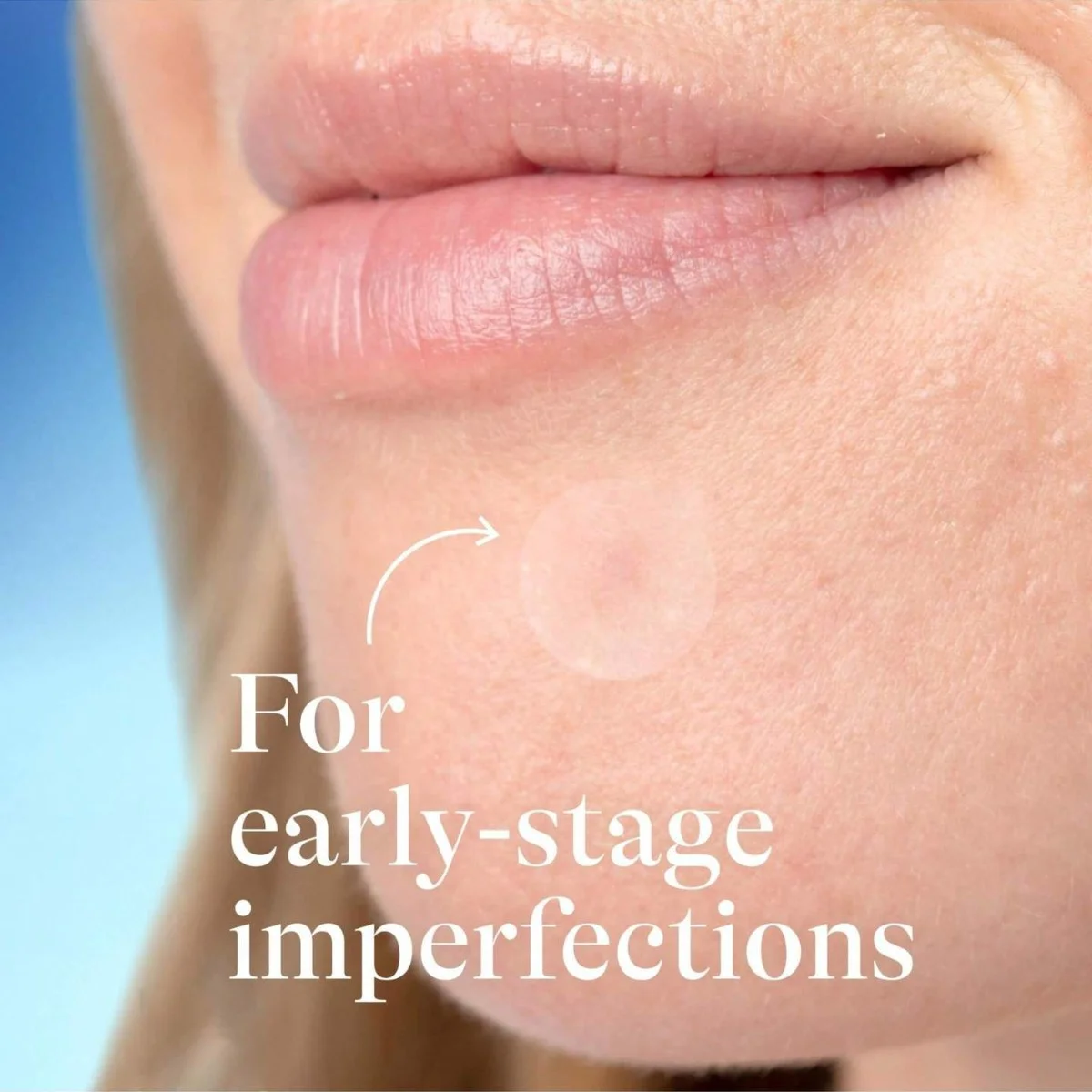 400 قطعة من رقع حب الشباب المستديرة بلون البشرة، غ...