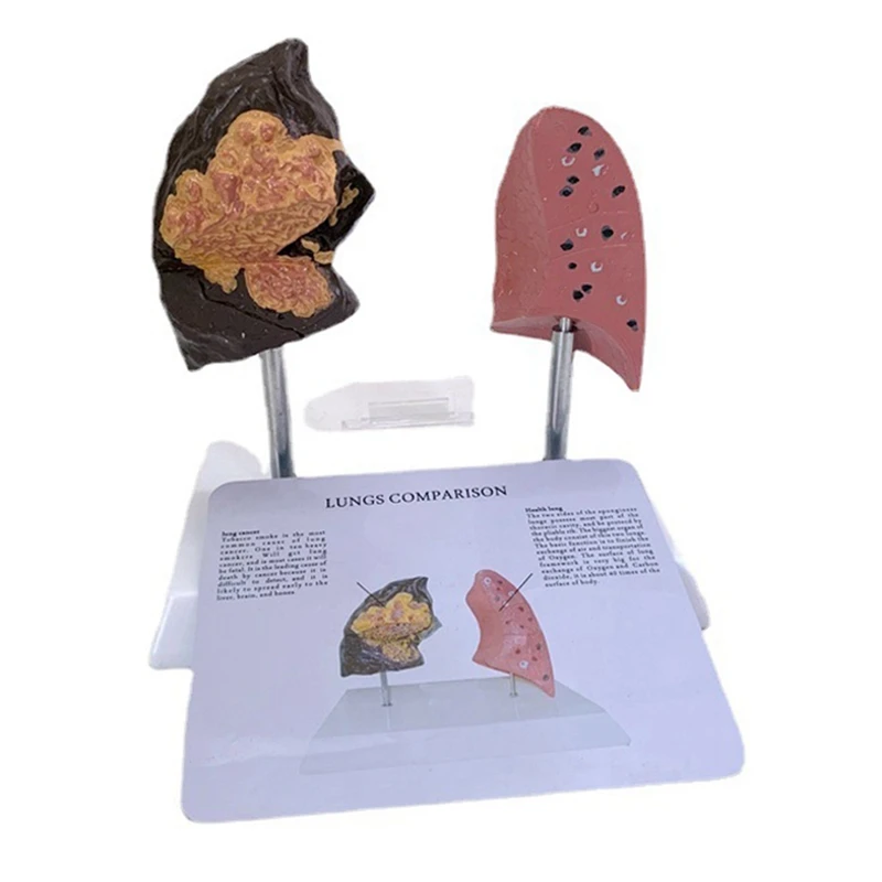 

Smoker's Lung Model Healthy Lung Model With Pathological Respiratory System Disease Lungs