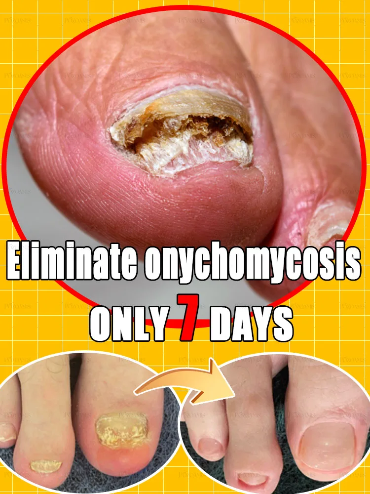 Fungus solution Solve fungus problem