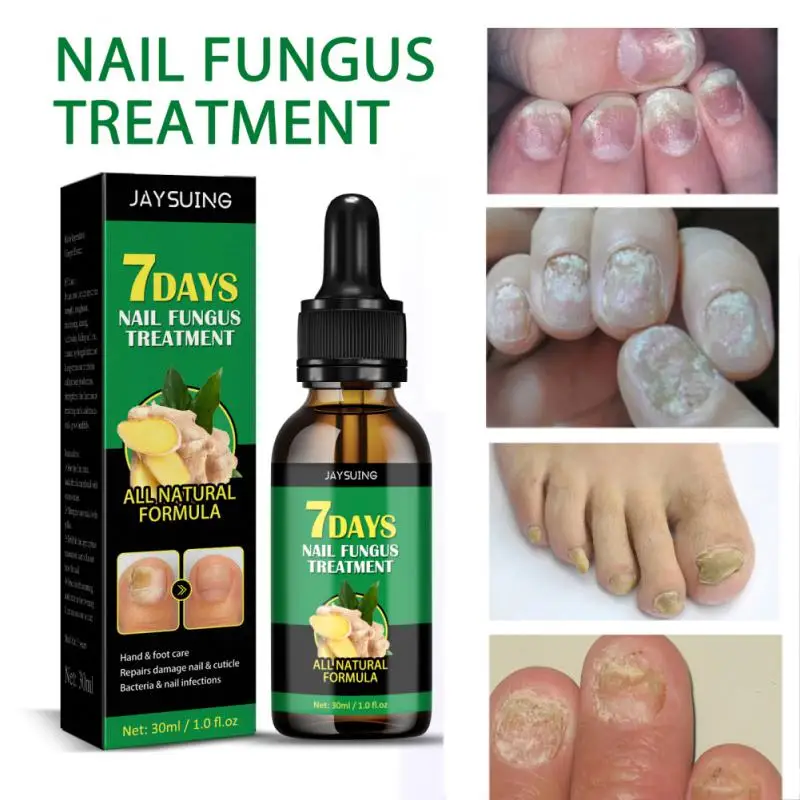 

7DAYS Nail Fungus Treatment Essence Serum Anti-Infection Onychomycosis Paronychia Hand Care Nails Foot Fungal Removal Gel 30ml