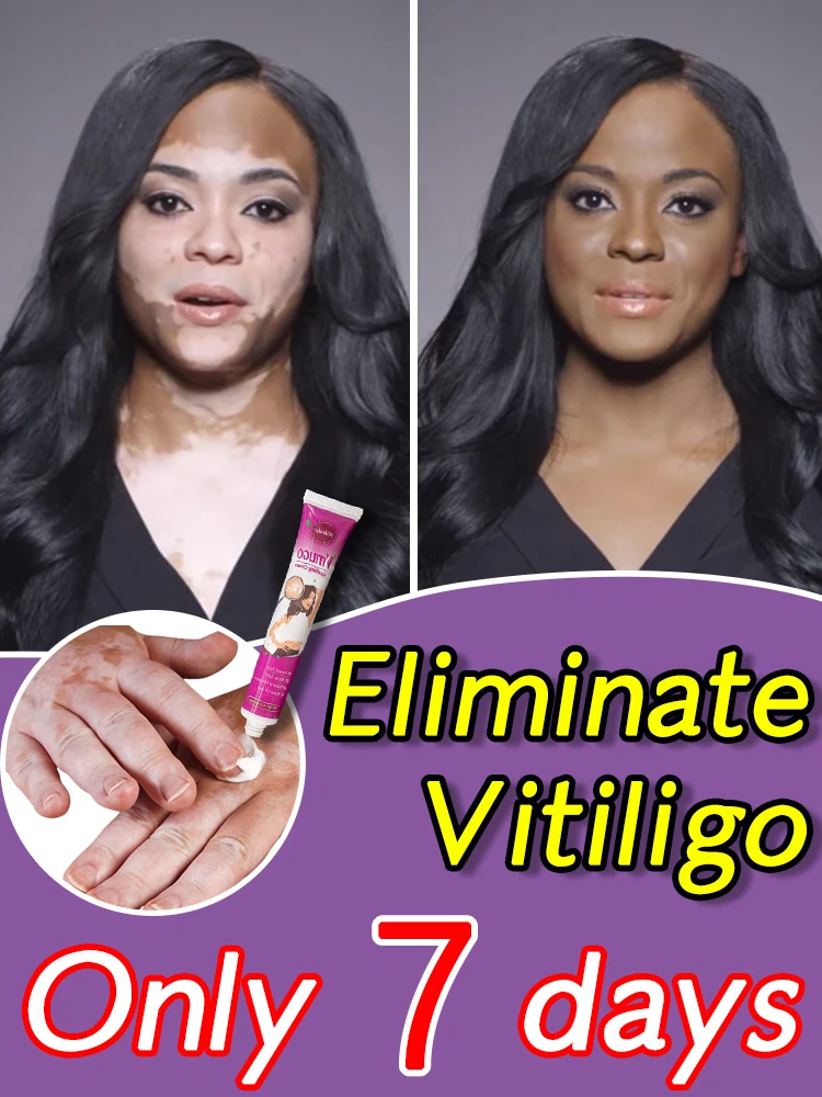 

Восстанавливающий Крем Vitiligo, мазь для ухода за кожей