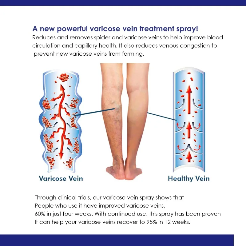 Body Cream 30ml Varicose Vein Spray Vasculitis Phlebitis Relief Cream Spider Legs Treatment Smoothing Blood Vessel Redness Herbal Body Care
