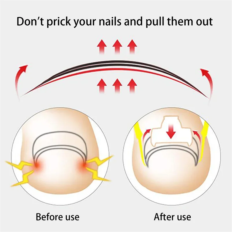 Ingrown Toe Nail Recover Correction Tool Pedicure Toenail Fixer Foot Nail Care Tool Orthotic Corrector Pedicure New ingrown toenail correction tool,manicure pedicure tool set,foot care tool,foot pedicure tool,toe corrector,nail problem solving,mens foot care product