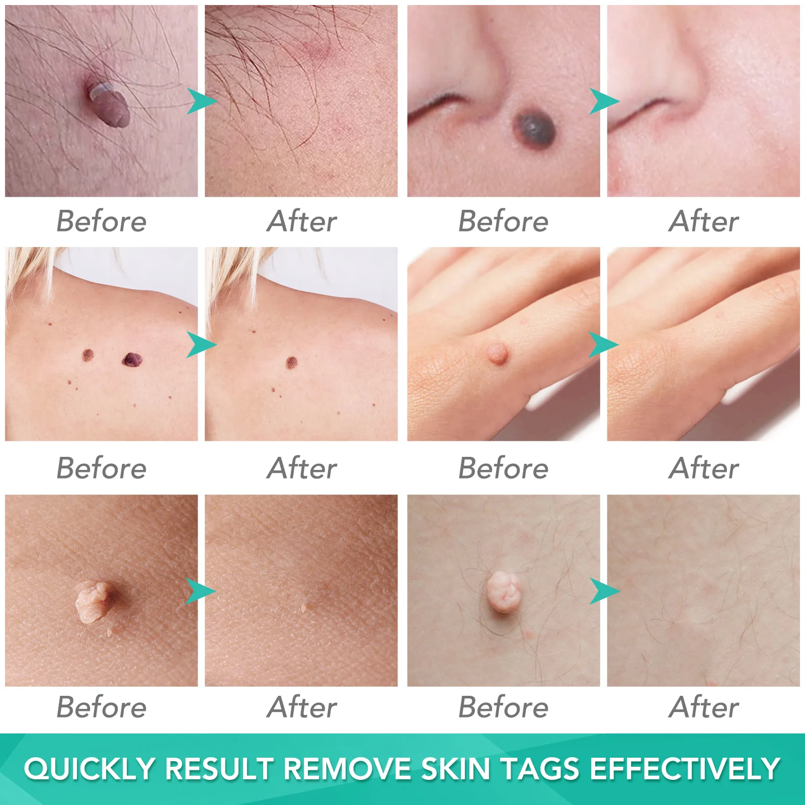 Skin Tag Removal Care Products Simple Wart Removal Tool Set Skin Tag Removeal Tool Easy To Clean Care