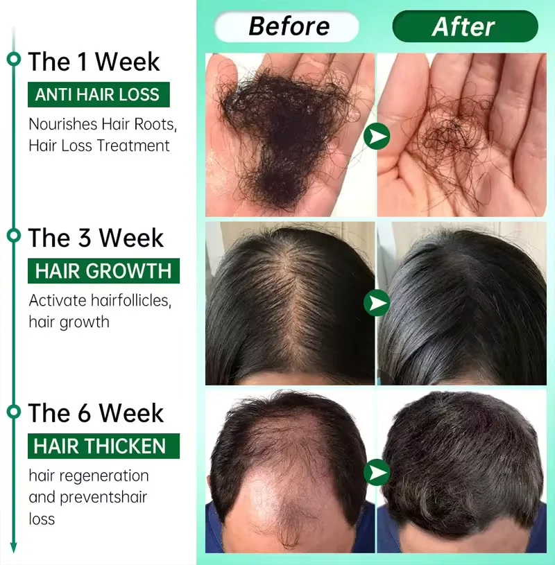 Hair Growth Serum Fast Ginger Hair Growth Spray Anti Hair Loss Regrowth Serum Scalp Damaged Repair Nourish Care for Women Men