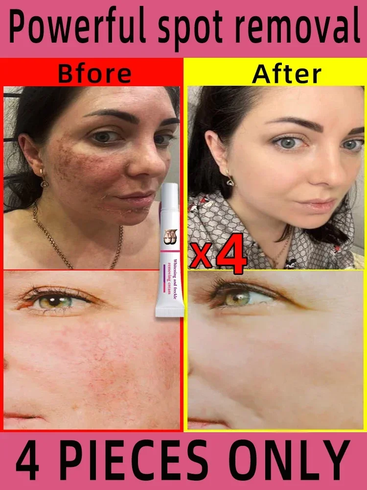 Freckles Removal Cream Remove Facial Spots Skin Dark Spot Remove Melasma Age Spots Sunspots Whitening And Freckle Removing Cream kapomi yellow peeling oil removal strong dark knuckles remove exfoliating scrub whitening cream for dark skin care product