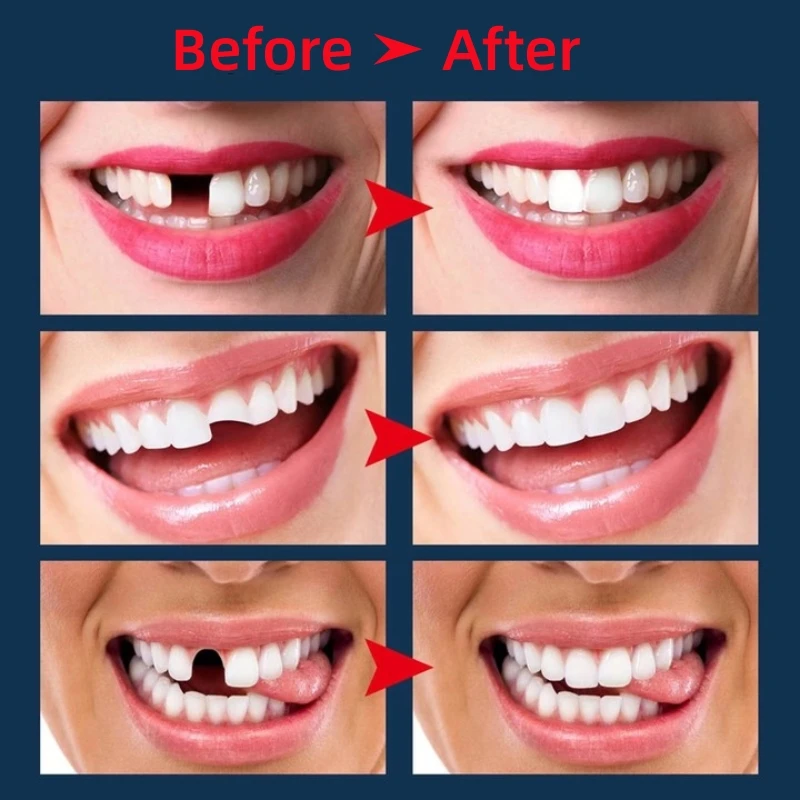 Tooth Filling Solid Denture Material Teeth BrokenTemporary Tooth Repair Solid Glue Flexible Acrylic DIY False Teeth Dental Care