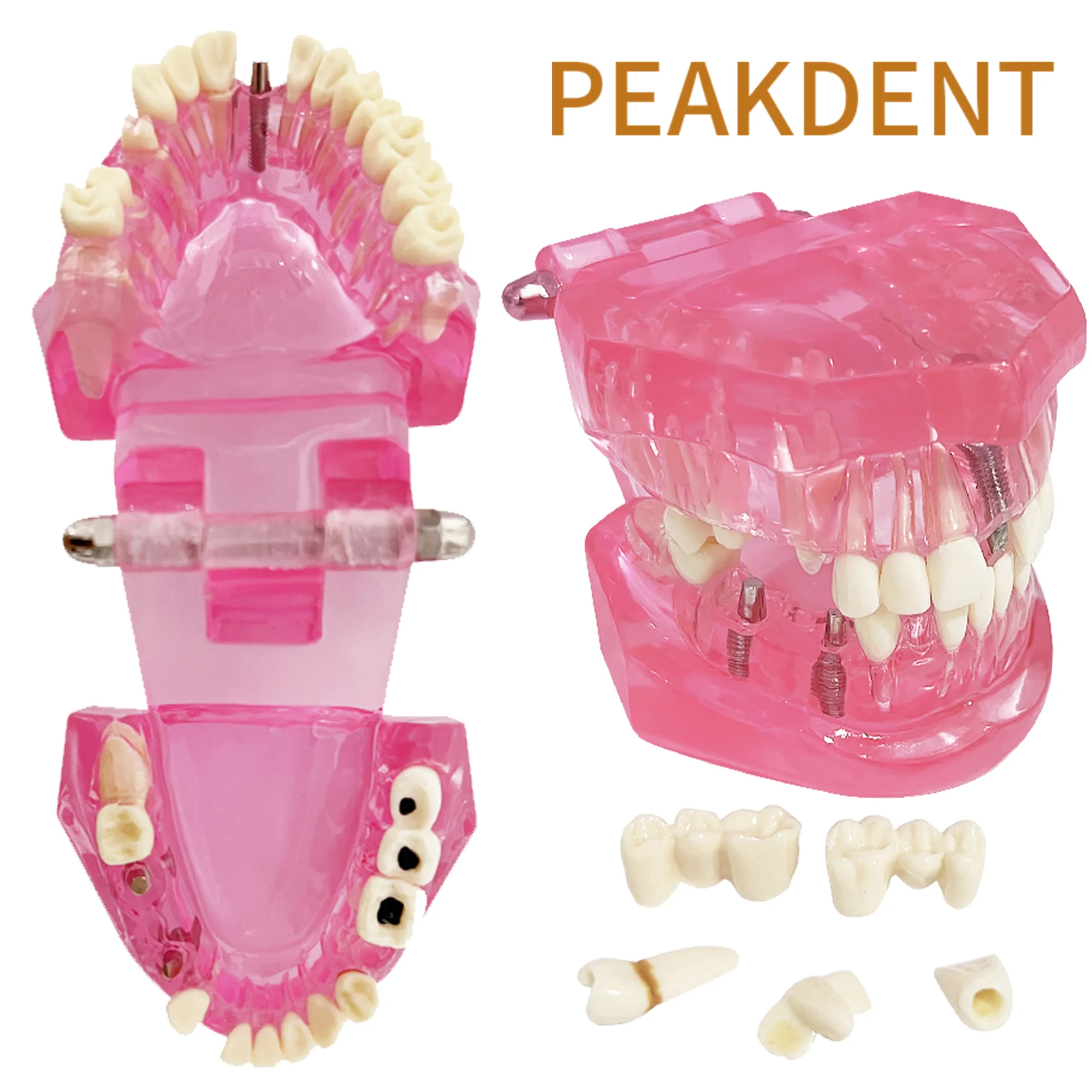 Sostituzione Denti: Tecniche E Costi Dell'impianto Dentale - Foto 2