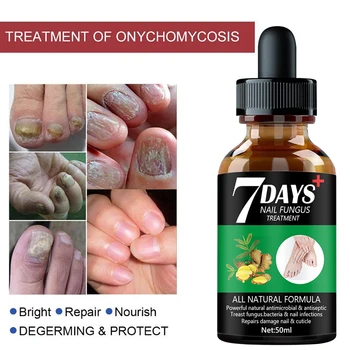 7DAYS Nail Fungus Treatment Essence Serum Care Hand and Foot Care Removal Repair Gel Anti-infective 6