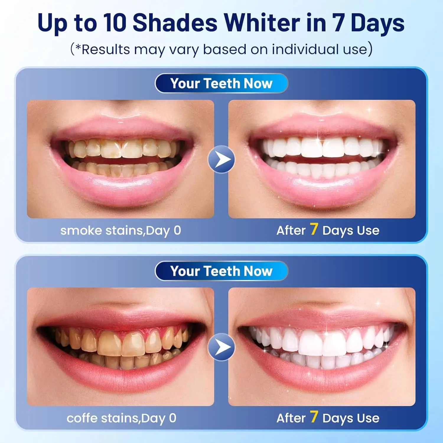 Kit Sbiancante per Denti con Luce LED, 4 Gel Sbiancanti e Gel Modellabile per Protesi, Aiuta a Rimuovere le Macchie Superficiali, Set per Igiene Orale - immagine 5