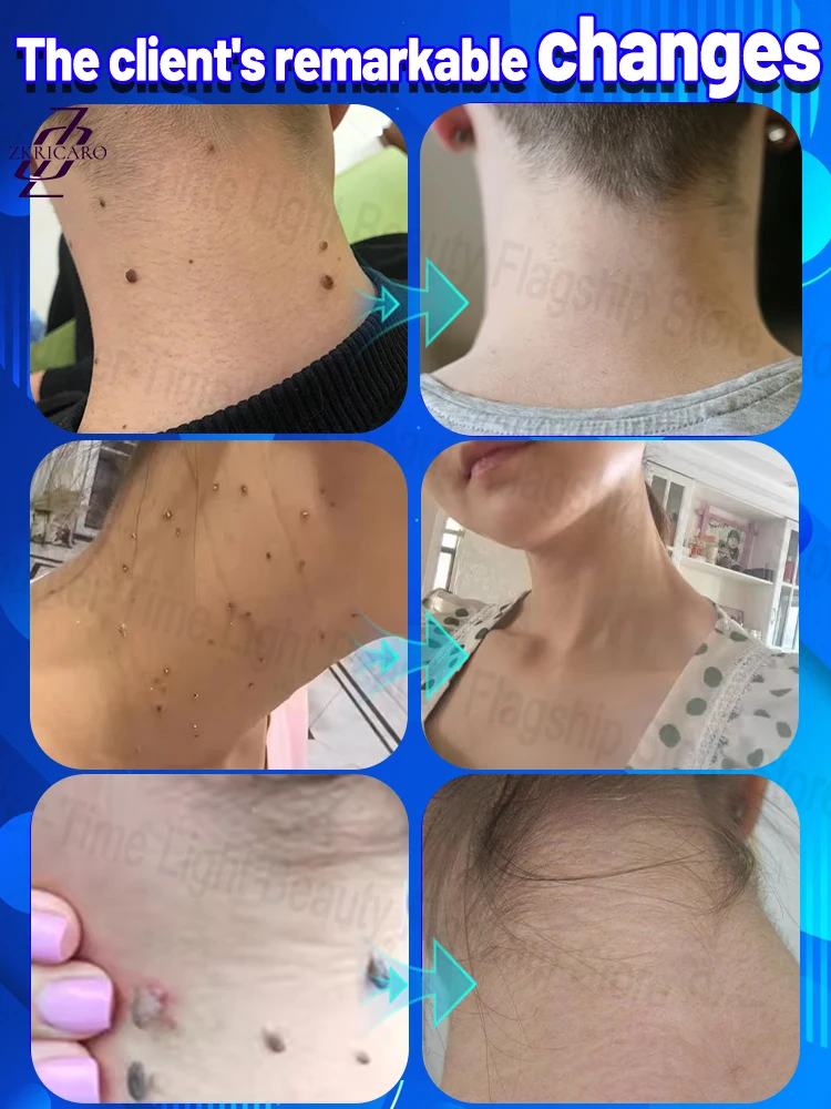 광속처럼 빠른 제모로 완벽한 피부를 선사합니다.