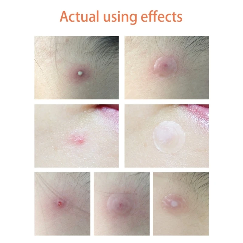 Acne stickers acne pimple patches acne removing invisible sticker remover mask patches day/night use skin care