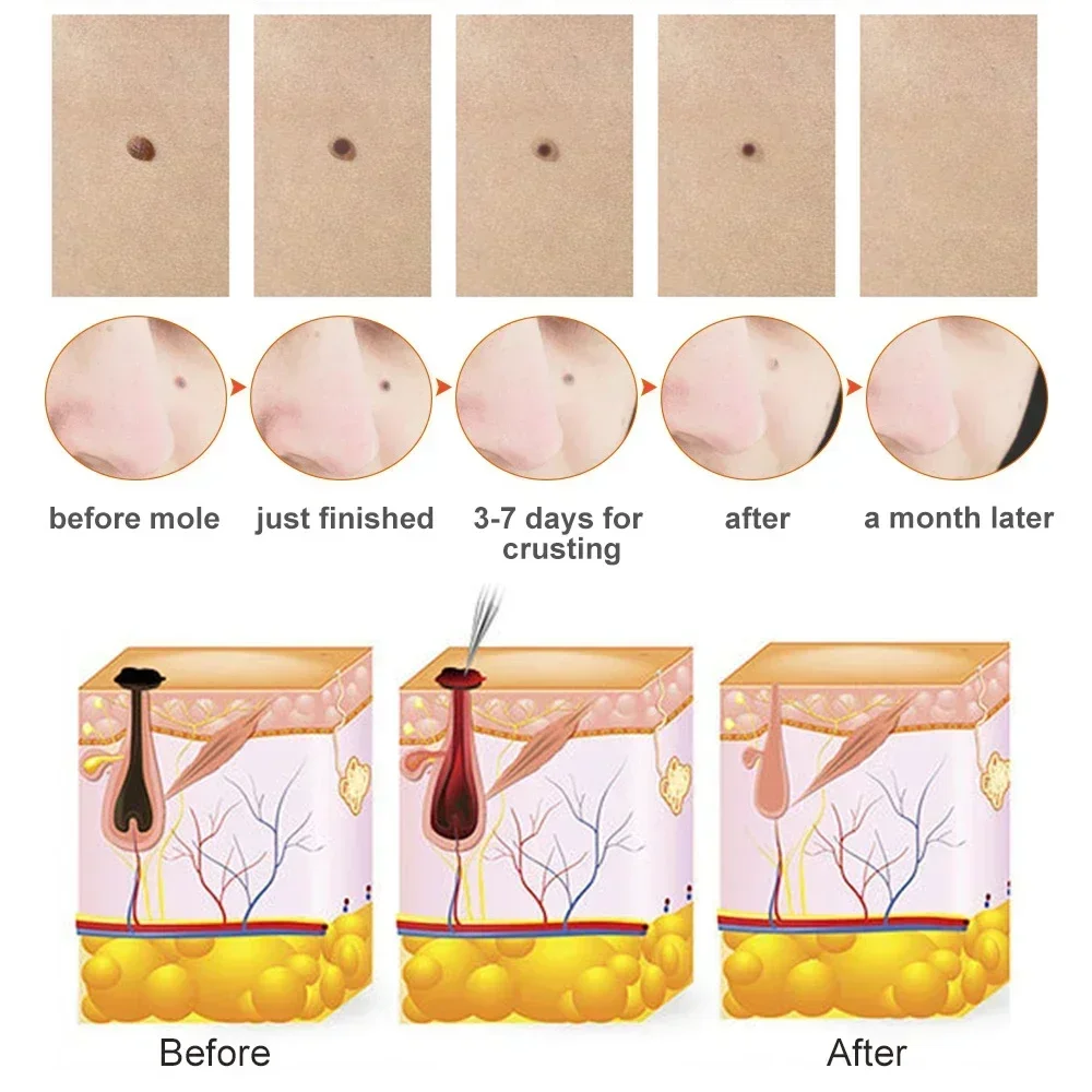Plasma Salon Pen Black Dots Vacuum Cleaner Laser Freckle Removal Machine Skin Mole Dark Spot Face Body Wart Tag Tattoo Remover facial beauty instrument skin tag remover laser plasma pen
