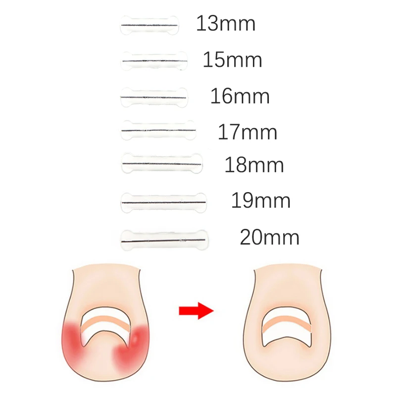 Ein gewachsene Zehen nagel korrektor Werkzeuge Pediküre erholen eingebettete Zehen nagel behandlung elastische Patch Aufkleber Glätten Clip Klammer 13-20mm