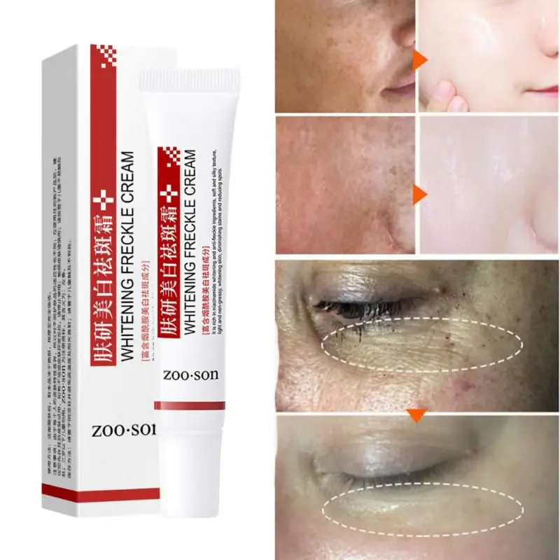 

Whitening Freckle Cream Effective Remove Dark Spots Anti Freckle Cream Fade Pigmentation Melasma Brighten Cream Face Care