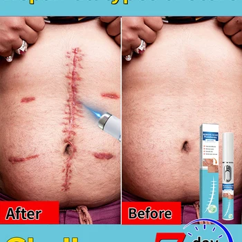 Hot Selling Laser Scar