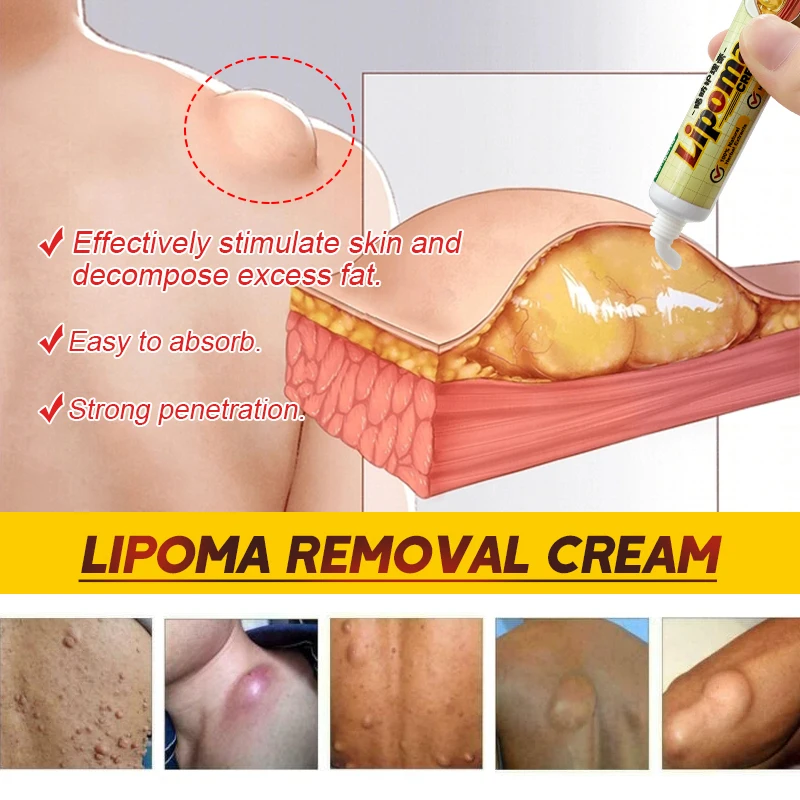 Pain relief cream,skin care ointment 1Pcs Lipoma Removal Cream Relief Pain Skin Swelling Lipolysis Cellulite Fat Lump Nodule Removal Ointment Anti-tumor Plaster G040
