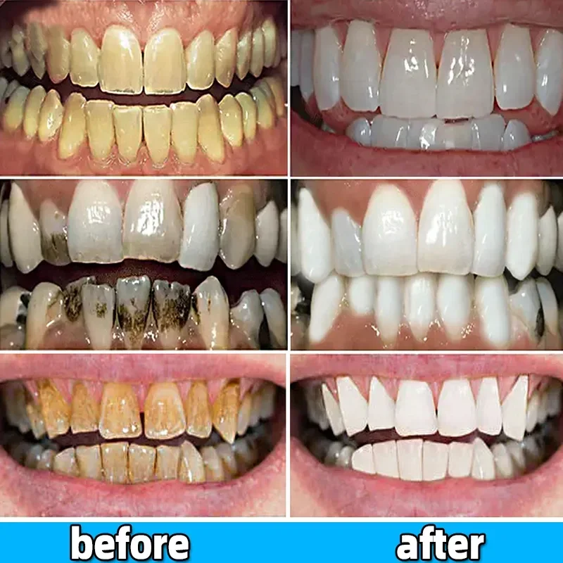 Usuwanie wybielająca pasta do zębów plamy z nieświeżego oddechu wybielacz zębów zapobiegający czyszczeniu przyzębia produkt dentystyczny 100g