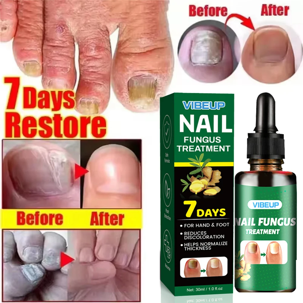 Fungal Nail Treatment Serum 7 Days Foot Nail Fungus Removal Repair Gel Anti Infection Paronychia Onychomycosis Foot Nails Care