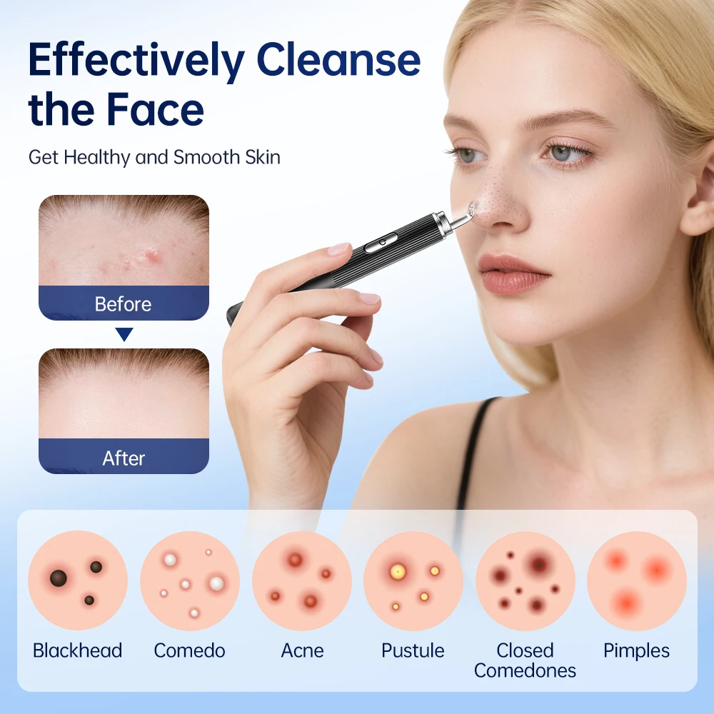 ABS Blackhead Remover Tool with 50X Magnification for Acne and Pore Cleaning